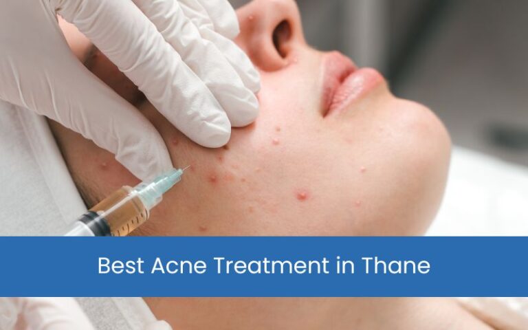 Acne Treatment in Thane