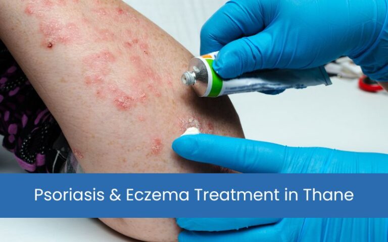 Psoriasis & Eczema Treatment in Thane – Expert Dermatological Care
