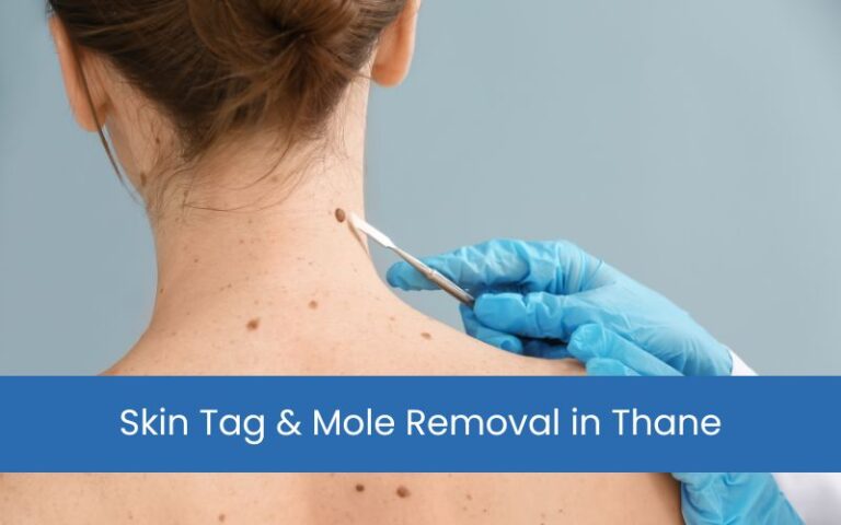Skin Tag & Mole Removal in Thane