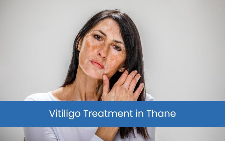 Vitiligo Treatment in Thane – Restoring Confidence with Expert Care